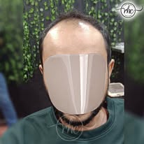 Before hair replacement