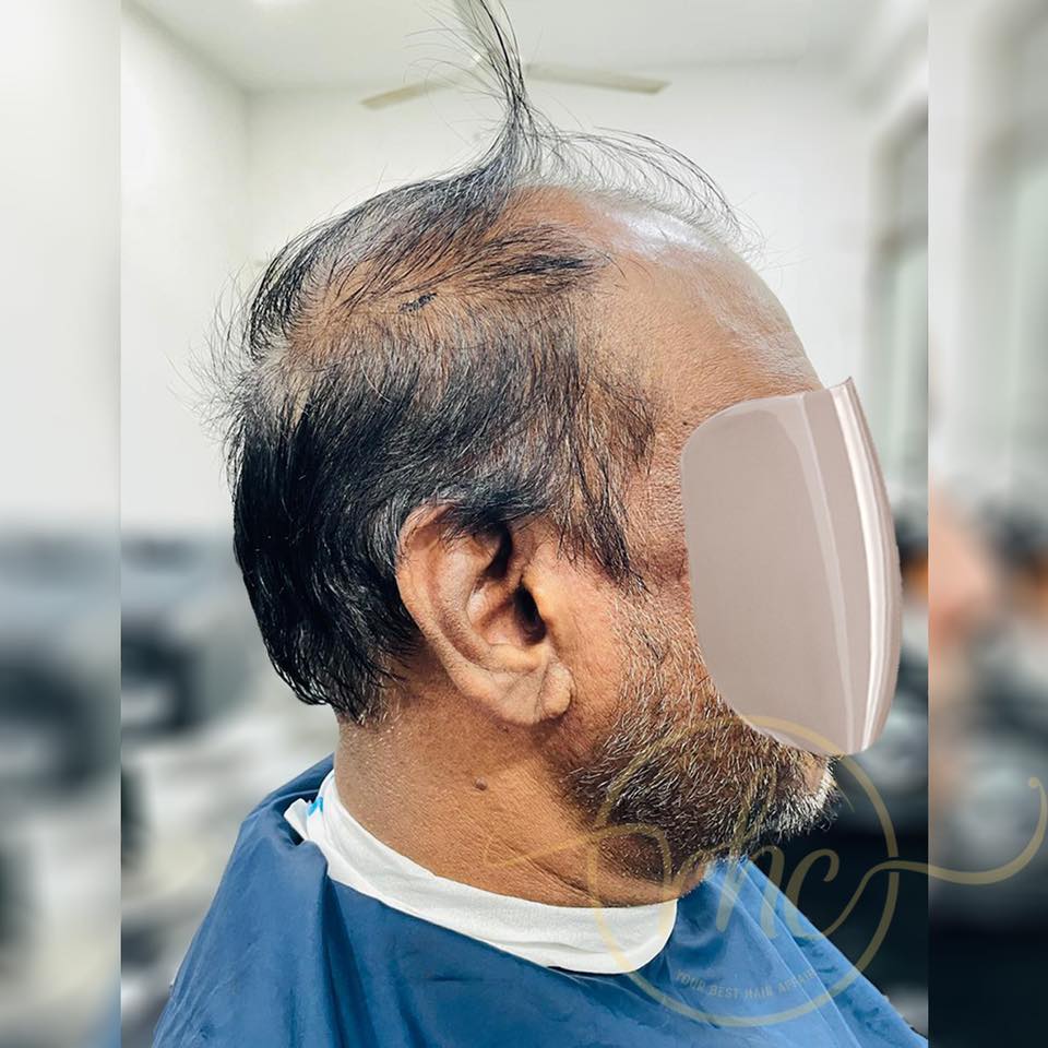 Before hair replacement