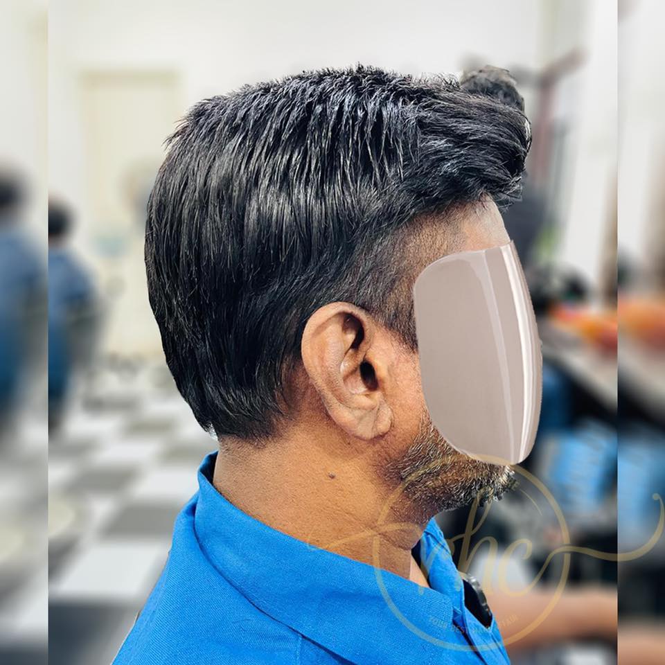 After hair replacement