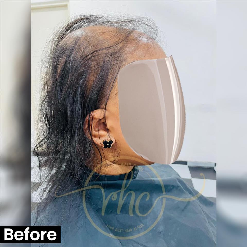 Before hair replacement