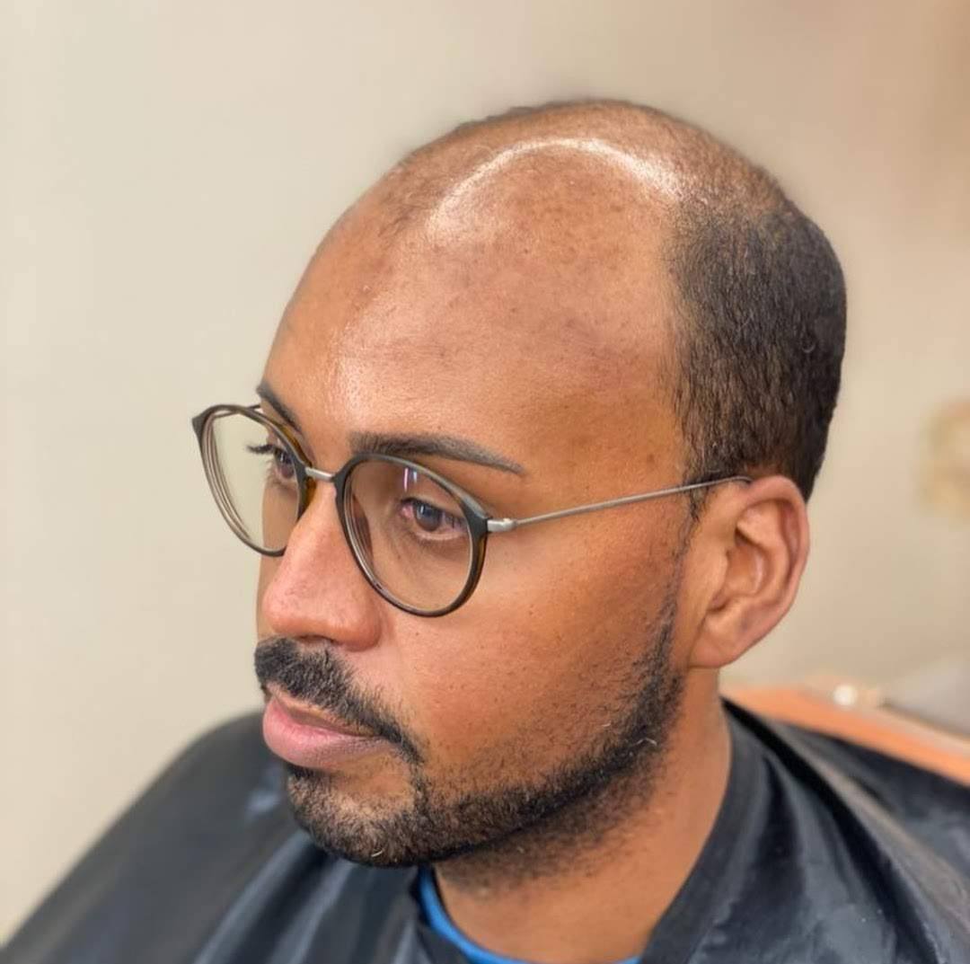 Before hair replacement