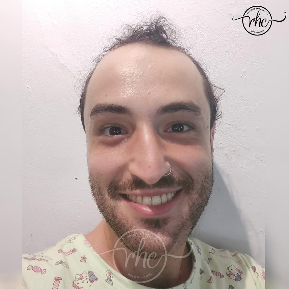 Before hair replacement