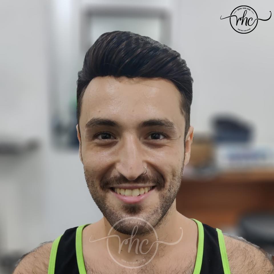 After hair replacement