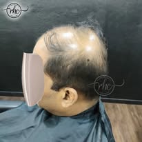 Before hair replacement