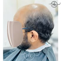 Before hair replacement