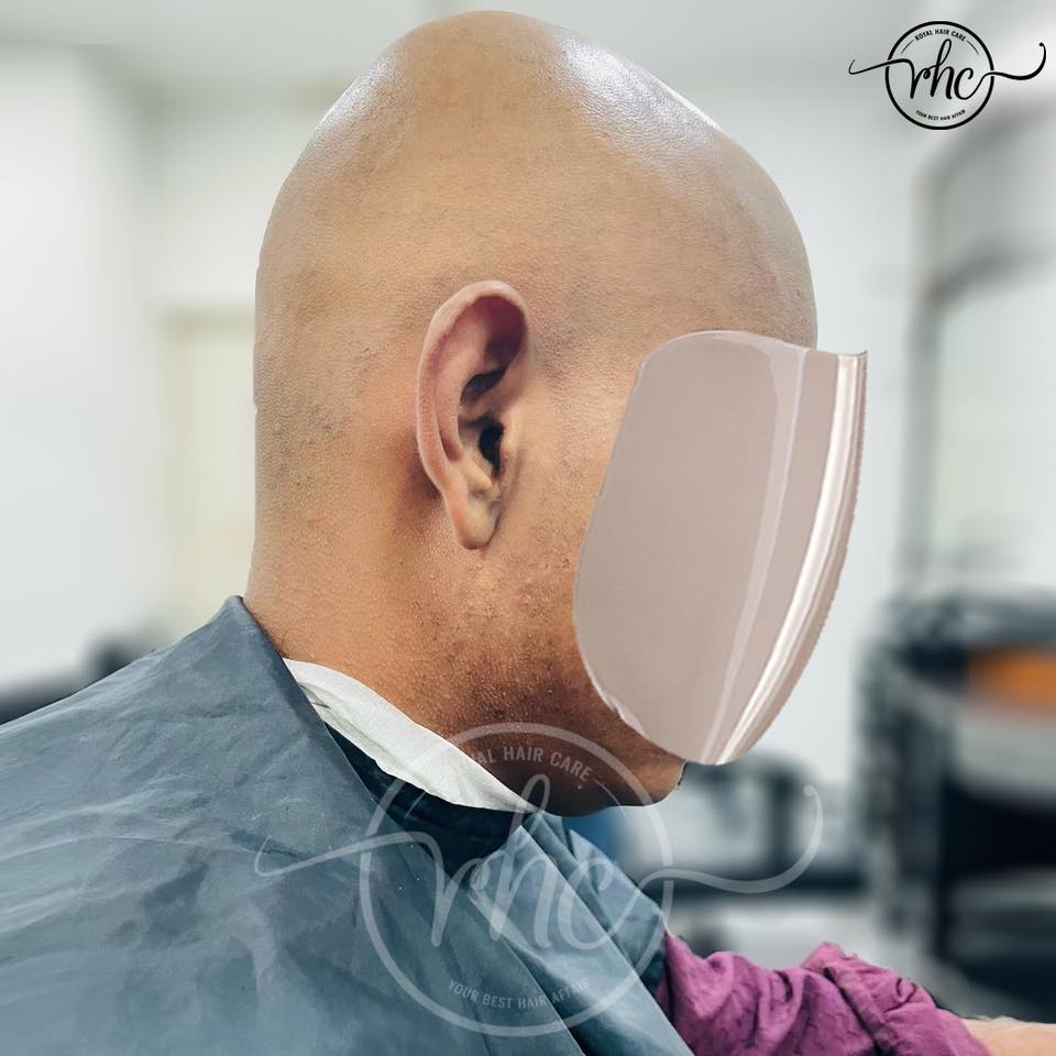 Hair Replacement Result