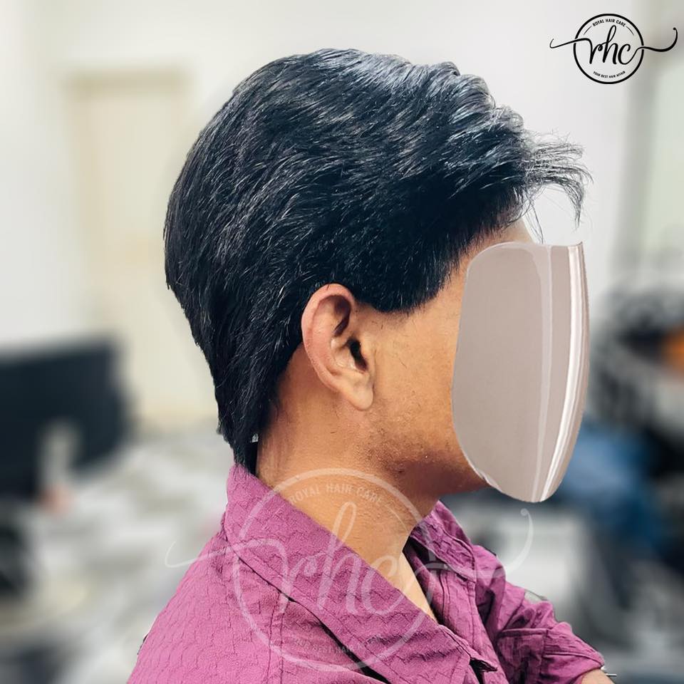 Hair Replacement Result